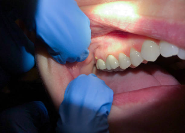 Best Emergency Treatment for Dental Infections or Abscesses in Shaker Heights, OH